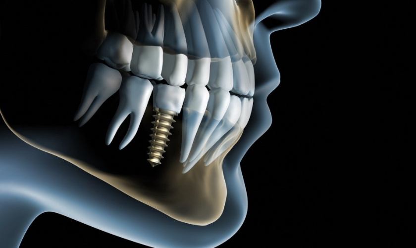 Why Do Dental Implants Break? How Can It Be Prevented?